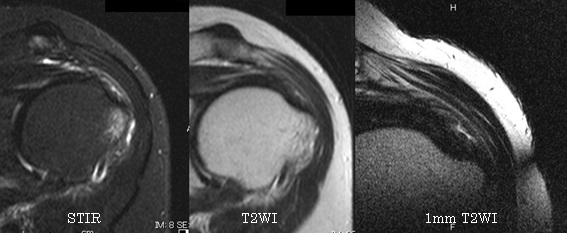 第42回日本磁気共鳴医学会大会/肩関節腱板の小さな断裂の診断における 